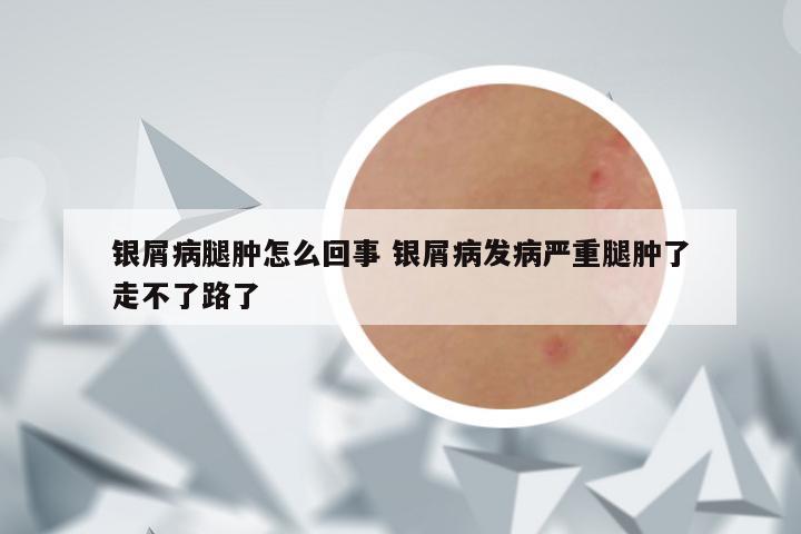 银屑病腿肿怎么回事 银屑病发病严重腿肿了走不了路了