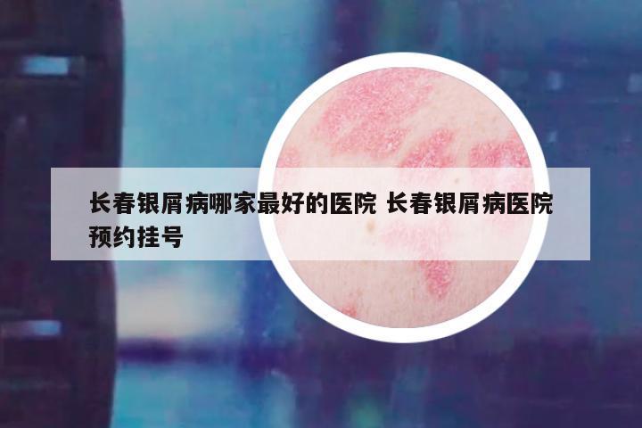 长春银屑病哪家最好的医院 长春银屑病医院预约挂号