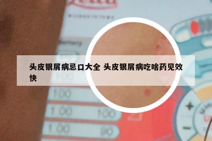 头皮银屑病忌口大全 头皮银屑病吃啥药见效快