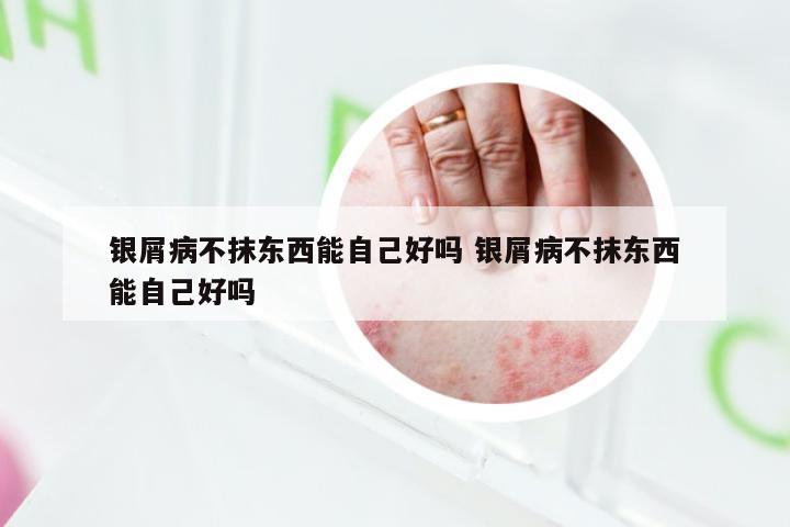 银屑病不抹东西能自己好吗 银屑病不抹东西能自己好吗