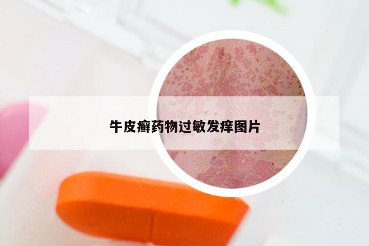 牛皮癣药物过敏发痒图片