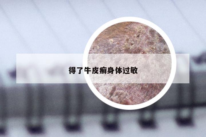得了牛皮癣身体过敏