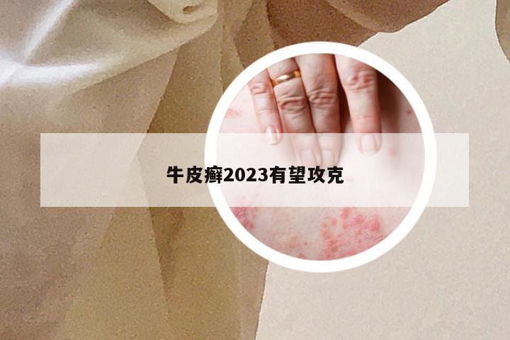 牛皮癣2023有望攻克