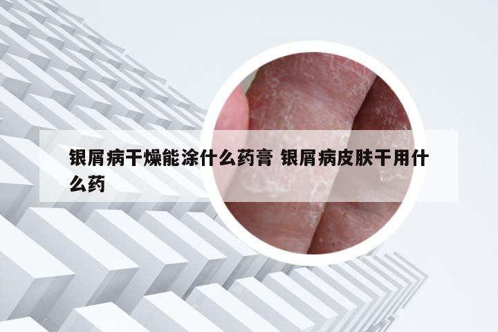 银屑病干燥能涂什么药膏 银屑病皮肤干用什么药