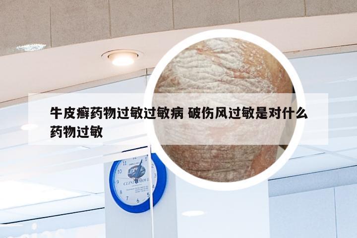 牛皮癣药物过敏过敏病 破伤风过敏是对什么药物过敏