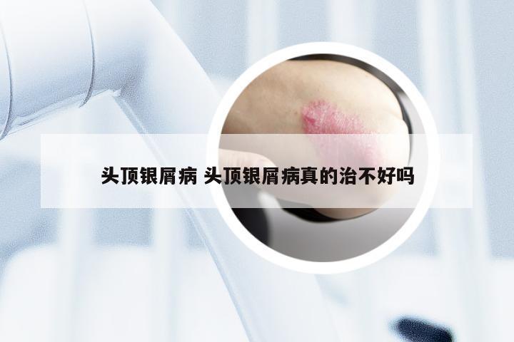 头顶银屑病 头顶银屑病真的治不好吗