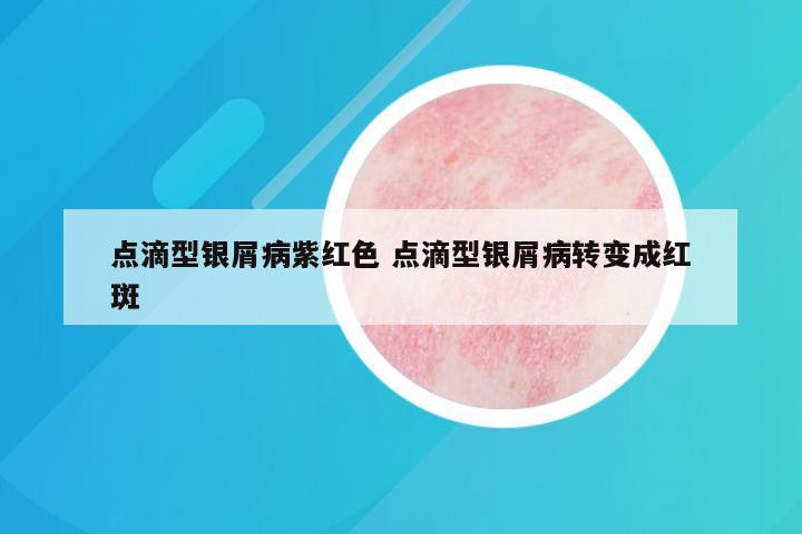 点滴型银屑病紫红色 点滴型银屑病转变成红斑