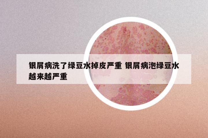银屑病洗了绿豆水掉皮严重 银屑病泡绿豆水越来越严重
