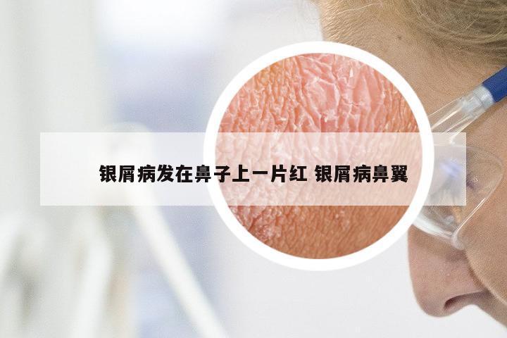 银屑病发在鼻子上一片红 银屑病鼻翼