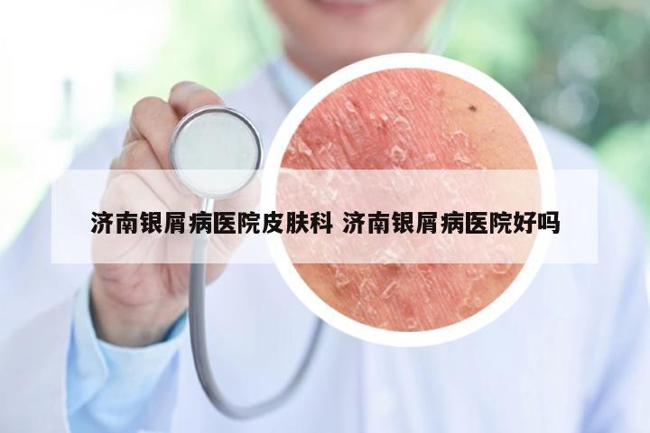 济南银屑病医院皮肤科 济南银屑病医院好吗