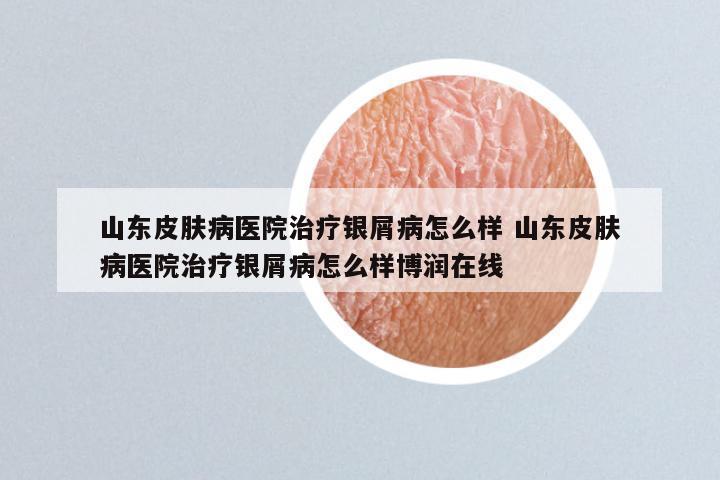 山东皮肤病医院治疗银屑病怎么样 山东皮肤病医院治疗银屑病怎么样博润在线