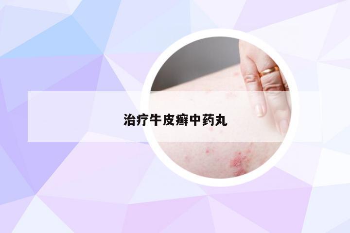 治疗牛皮癣中药丸
