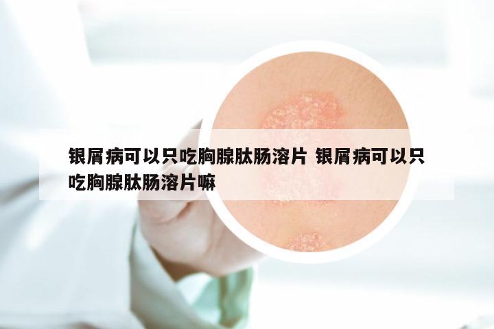 银屑病可以只吃胸腺肽肠溶片 银屑病可以只吃胸腺肽肠溶片嘛