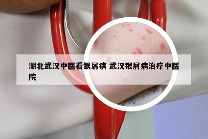 湖北武汉中医看银屑病 武汉银屑病治疗中医院