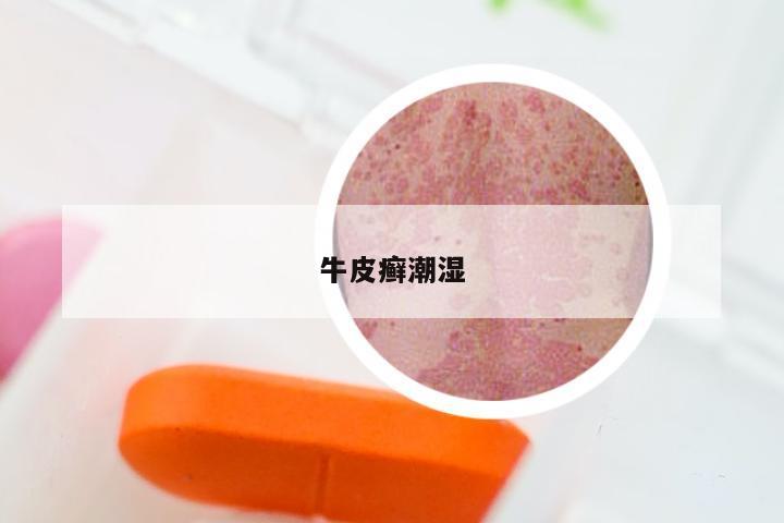 牛皮癣潮湿