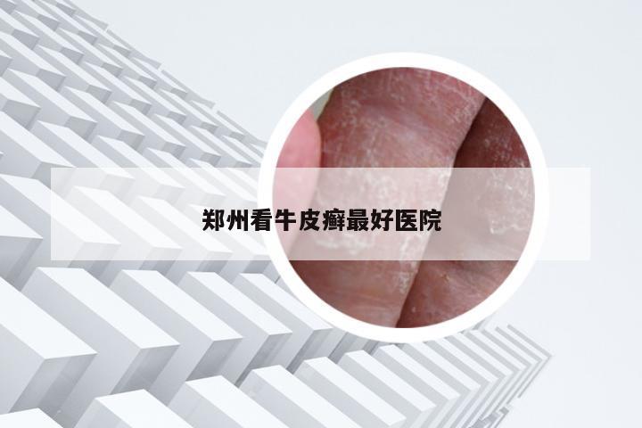 郑州看牛皮癣最好医院
