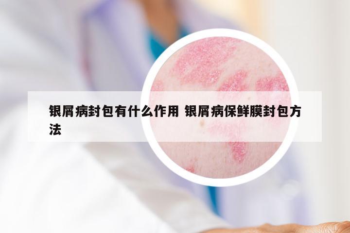 银屑病封包有什么作用 银屑病保鲜膜封包方法