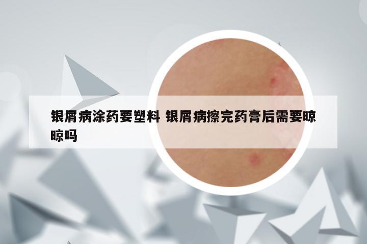 银屑病涂药要塑料 银屑病擦完药膏后需要晾晾吗