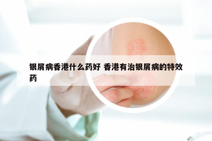 银屑病香港什么药好 香港有治银屑病的特效药