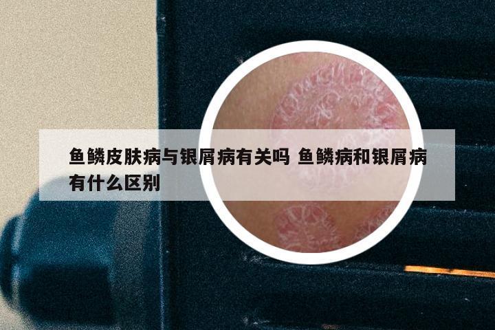 鱼鳞皮肤病与银屑病有关吗 鱼鳞病和银屑病有什么区别