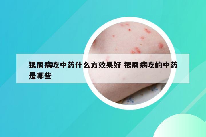 银屑病吃中药什么方效果好 银屑病吃的中药是哪些