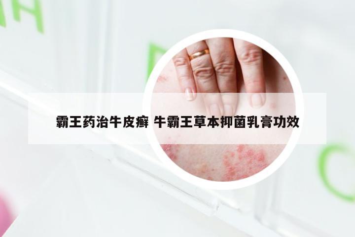 霸王药治牛皮癣 牛霸王草本抑菌乳膏功效