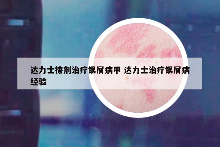 达力士擦剂治疗银屑病甲 达力士治疗银屑病经验