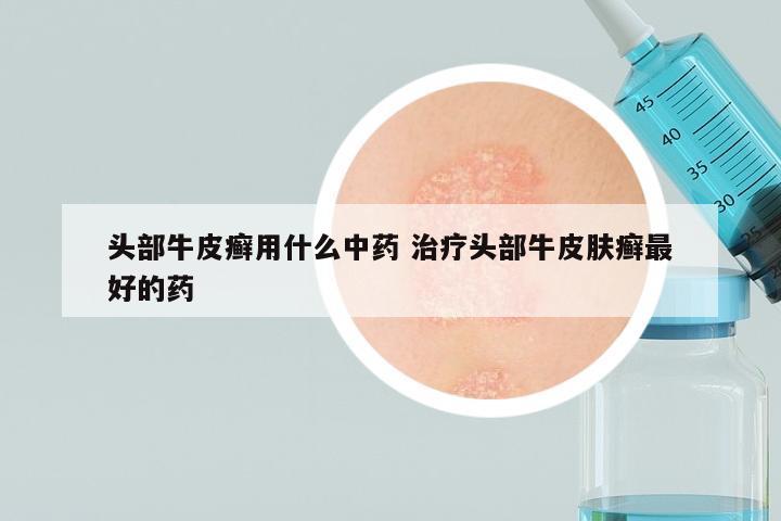 头部牛皮癣用什么中药 治疗头部牛皮肤癣最好的药