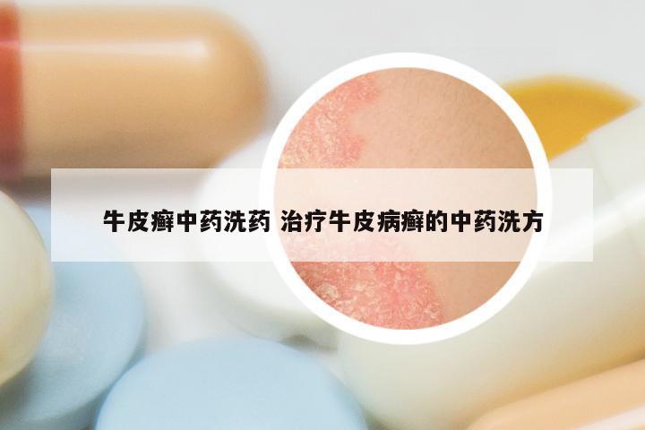 牛皮癣中药洗药 治疗牛皮病癣的中药洗方