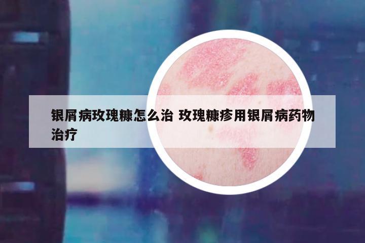银屑病玫瑰糠怎么治 玫瑰糠疹用银屑病药物治疗