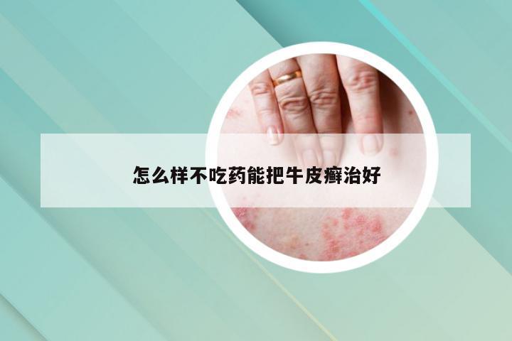 怎么样不吃药能把牛皮癣治好