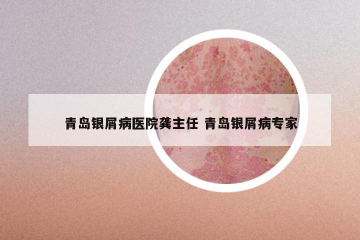 青岛银屑病医院龚主任 青岛银屑病专家
