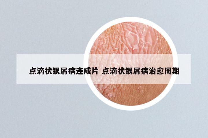 点滴状银屑病连成片 点滴状银屑病治愈周期