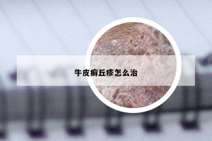 牛皮癣丘疹怎么治