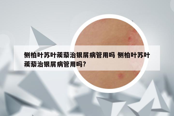 侧柏叶苏叶蒺藜治银屑病管用吗 侧柏叶苏叶蒺藜治银屑病管用吗?