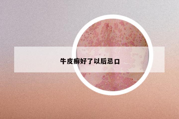 牛皮癣好了以后忌口