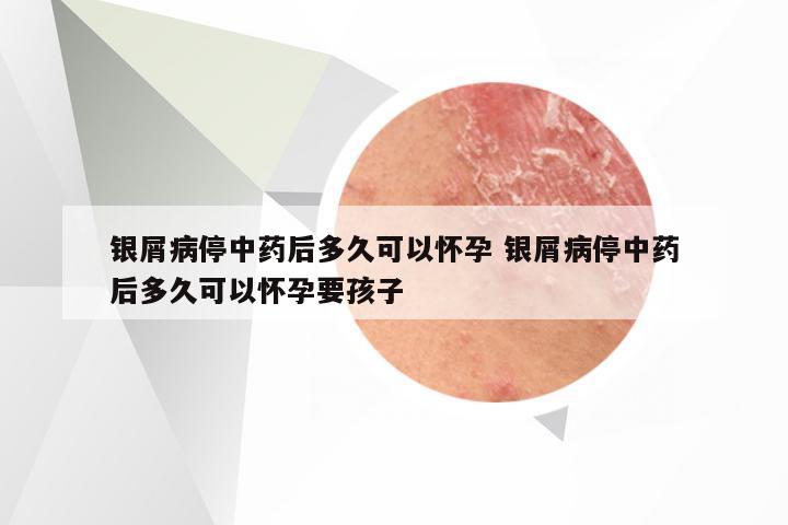 银屑病停中药后多久可以怀孕 银屑病停中药后多久可以怀孕要孩子