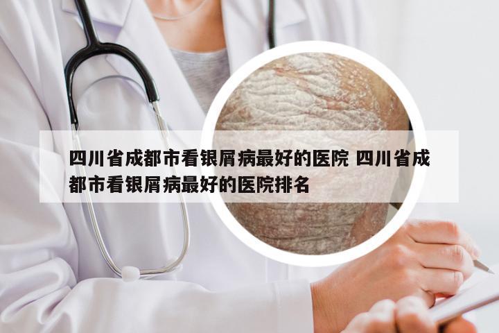 四川省成都市看银屑病最好的医院 四川省成都市看银屑病最好的医院排名