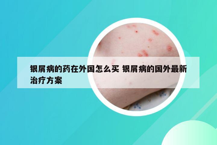 银屑病的药在外国怎么买 银屑病的国外最新治疗方案