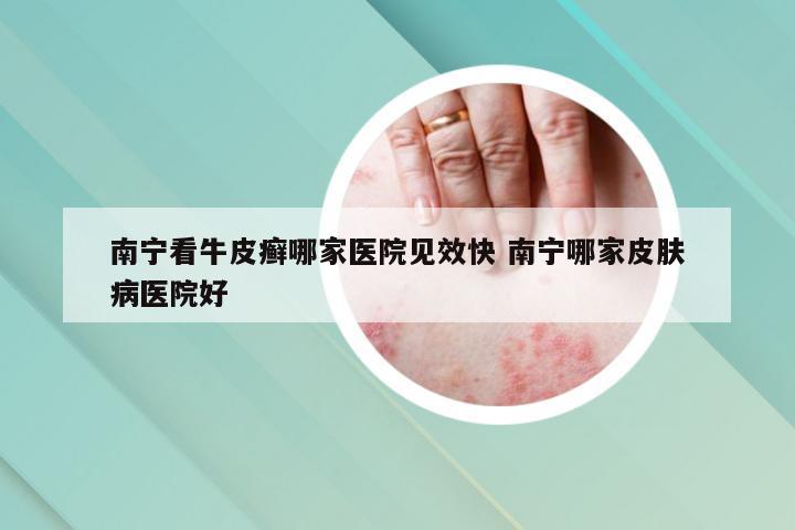 南宁看牛皮癣哪家医院见效快 南宁哪家皮肤病医院好