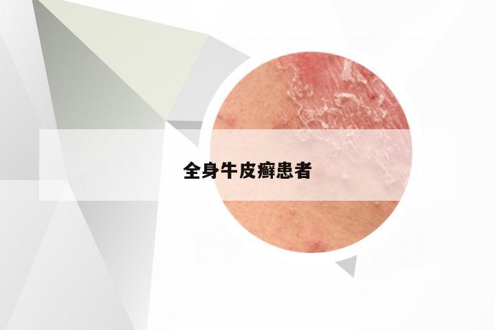全身牛皮癣患者