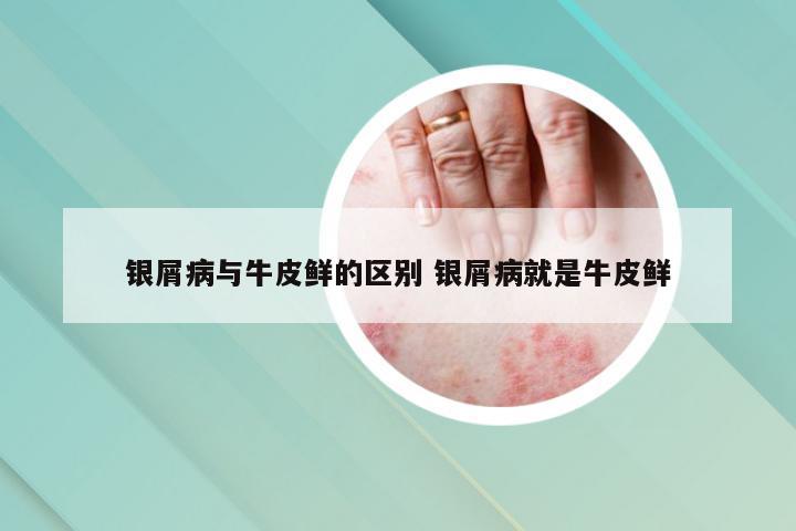 银屑病与牛皮鲜的区别 银屑病就是牛皮鲜