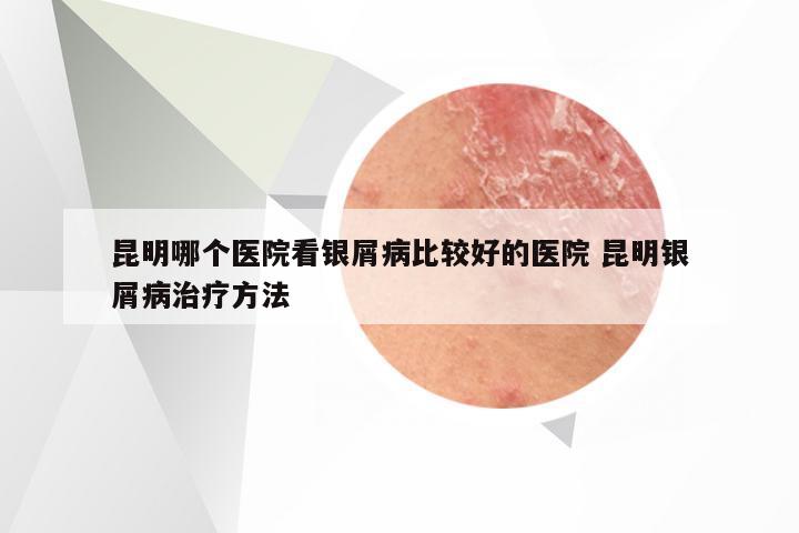 昆明哪个医院看银屑病比较好的医院 昆明银屑病治疗方法