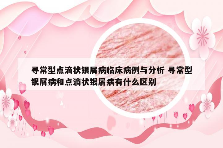 寻常型点滴状银屑病临床病例与分析 寻常型银屑病和点滴状银屑病有什么区别