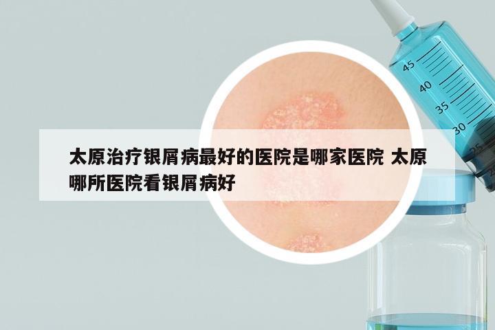 太原治疗银屑病最好的医院是哪家医院 太原哪所医院看银屑病好