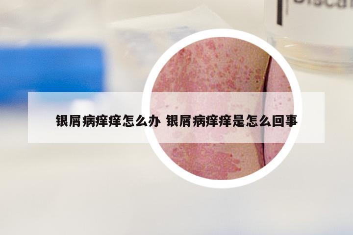 银屑病痒痒怎么办 银屑病痒痒是怎么回事