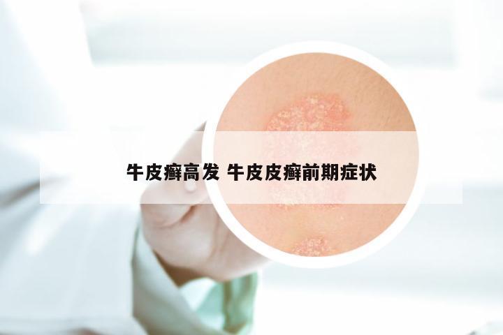 牛皮癣高发 牛皮皮癣前期症状