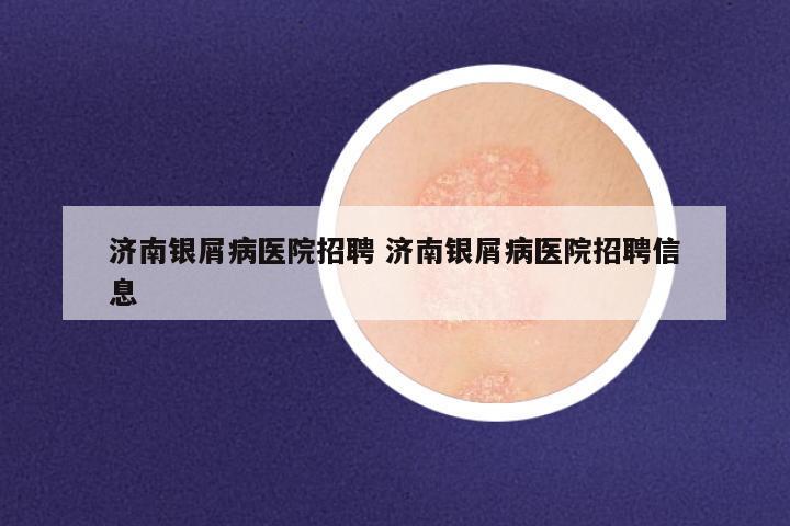 济南银屑病医院招聘 济南银屑病医院招聘信息