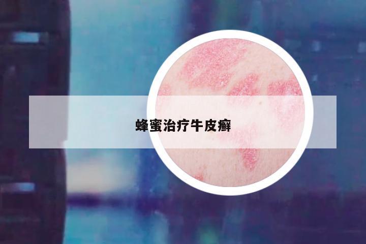 蜂蜜治疗牛皮癣