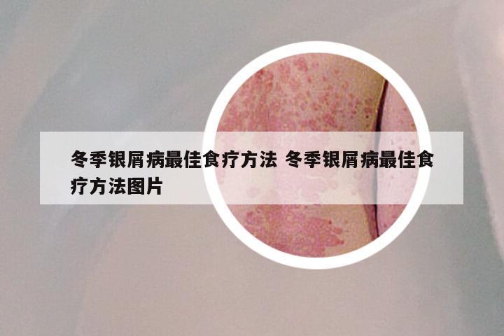 冬季银屑病最佳食疗方法 冬季银屑病最佳食疗方法图片